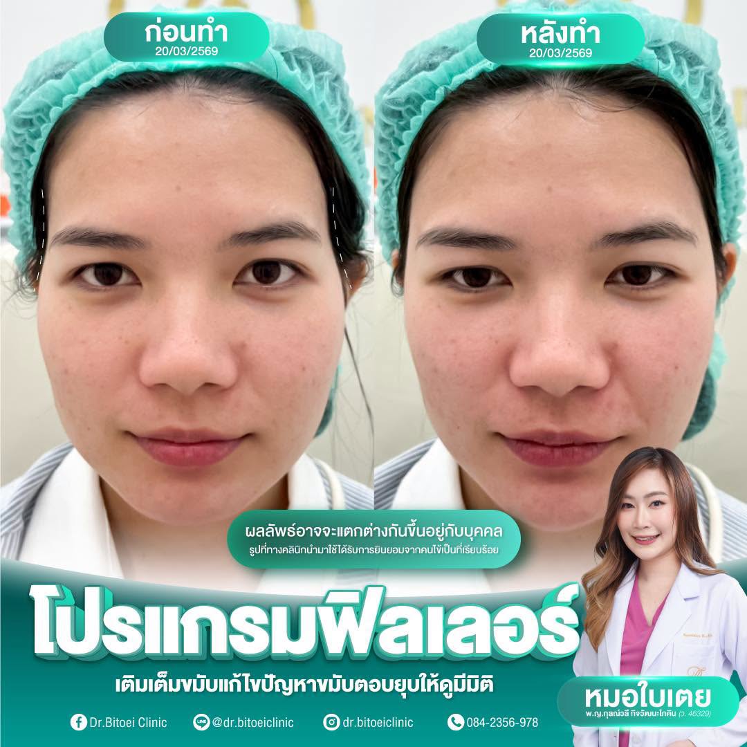ภาพประกอบบริการ ฟิลเลอร์ จาก Dr.Bitoei Clinic