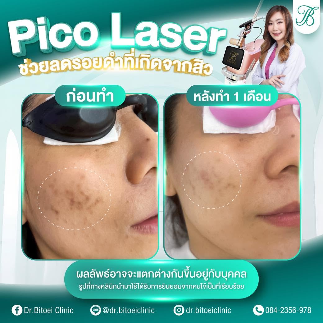 ภาพประกอบบริการ Pico Laser จาก Dr.Bitoei Clinic
