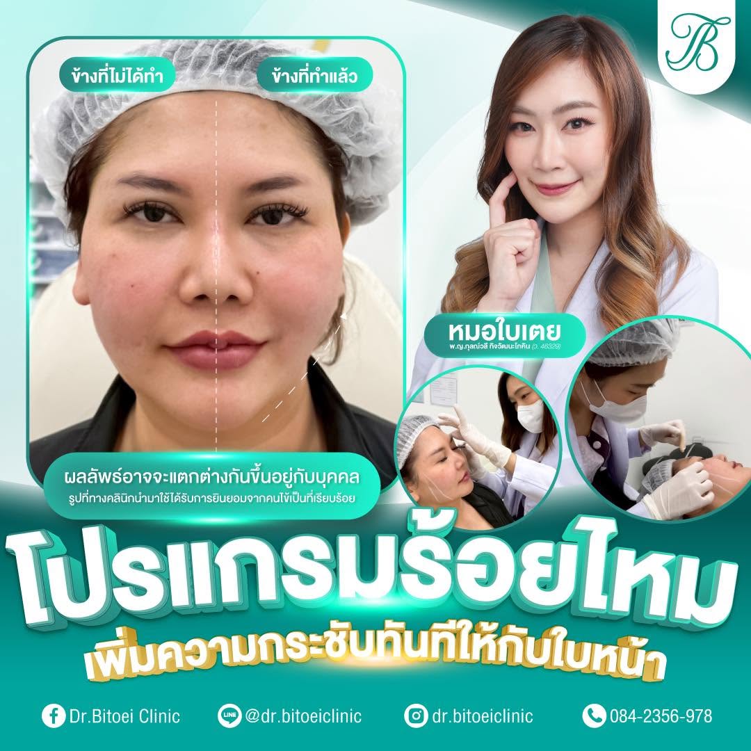 ภาพประกอบบริการ ร้อยไหม จาก Dr.Bitoei Clinic